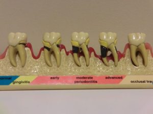 歯周病とはどのような病気でしょうか？病態と特徴