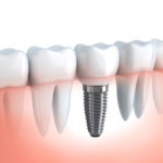 歯の土台である歯槽骨の再生