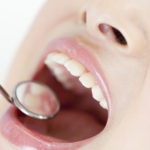 口内炎（一般的な治療法）