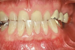 噛み合わせと審美性に問題