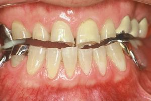 噛みあわせの改善を図ります