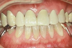 ラミッククラウンにて修復