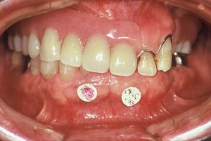 歯並びが傾いている