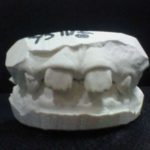「ハ」の字状態の子供の前歯　前歯の歯並び