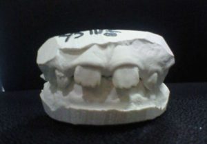 「ハ」の字状態の子供の前歯　前歯の歯並び