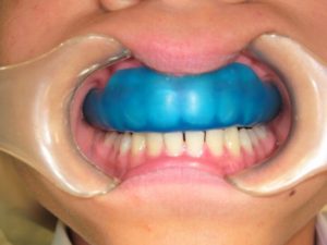 スポーツマウスガード